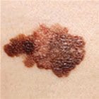 A misshapen melanoma brown spot, close up.