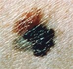 A misshapen and discolored melanoma brown spot with black, close up.