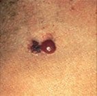 A raised, red blister-like melanoma next to a misshapen melanoma brown spot.