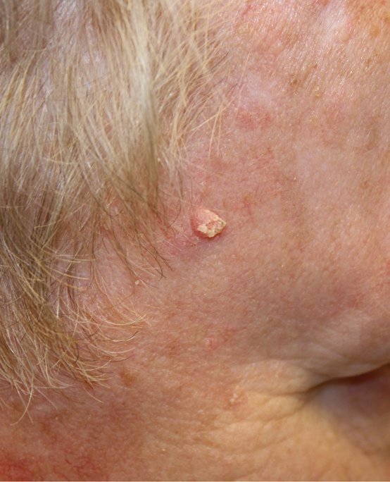 A raised squamous cell carcinoma spot on a mans temple, close up.