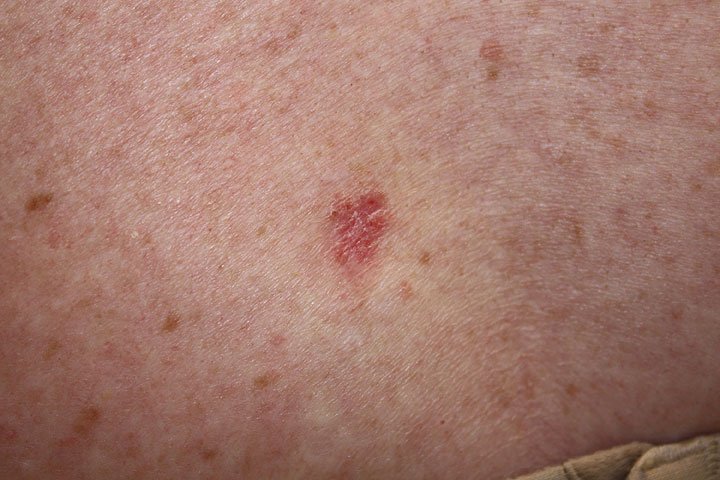 A red basal cell carcinoma skin-spot, close up.